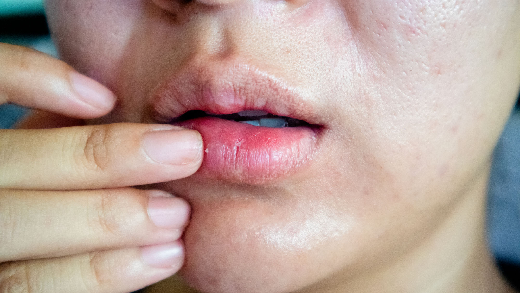 dry-chapped-peeling-lips-dry-skin-problem-with-mouth-disease (1)